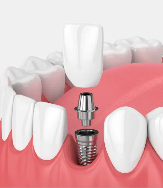 Dental Implantation