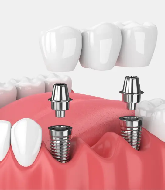 Three Teeth Restoration With Bridge On Implants