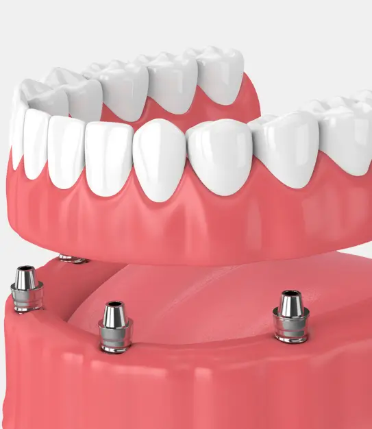 Tooth Restoration With The "All On 4" METHOD