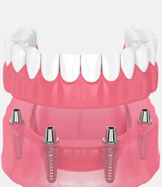 Tooth Restoration With The "All On 4" METHOD Within 24 Hours