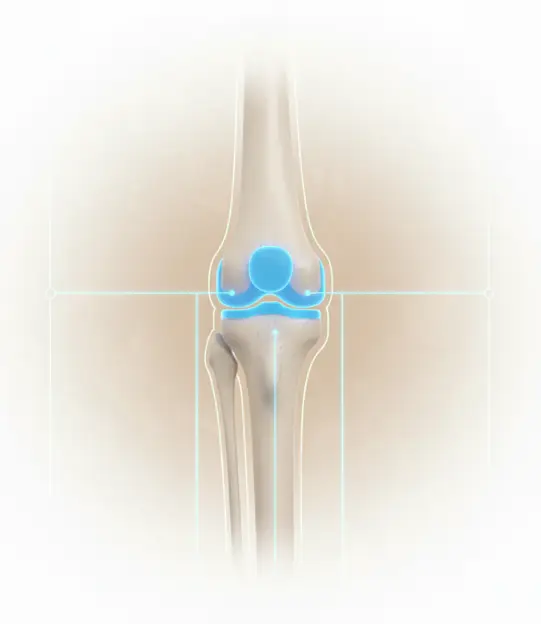 Knee replacement surgery