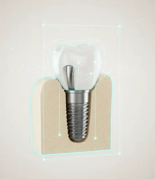 Single Tooth Implantation