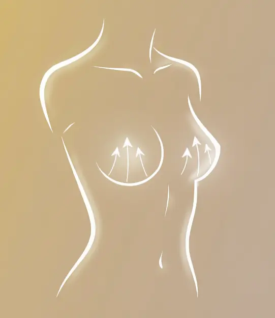 Krūtų pakėlimas