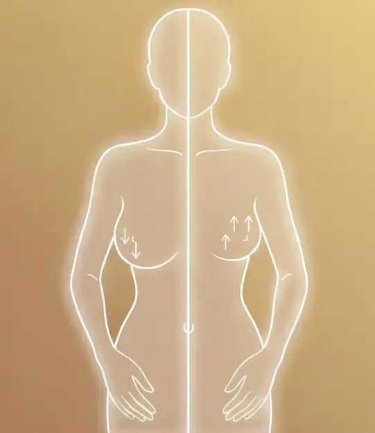 Breast reduction