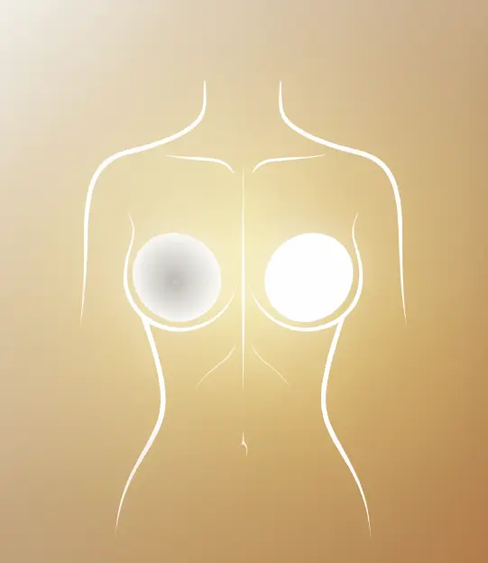 Breast implant replacement