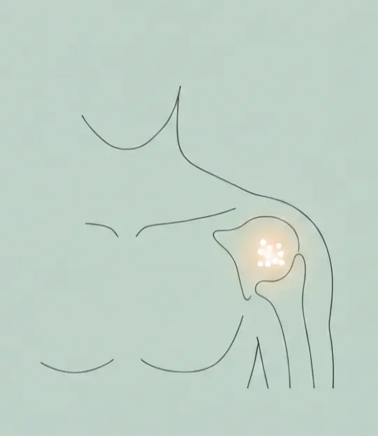 Arthroscopic surgery for shoulder calcifications