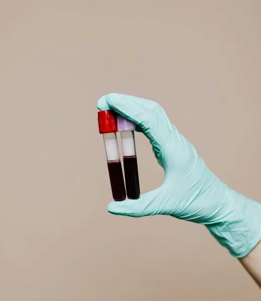 PRP treatment