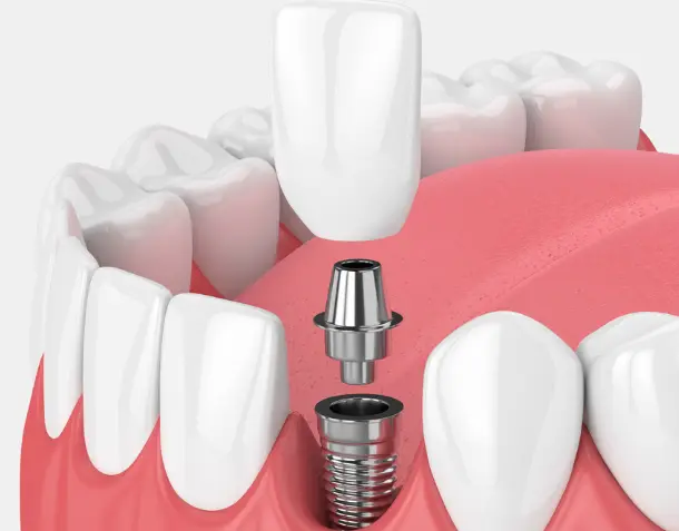 Dental Implantation
