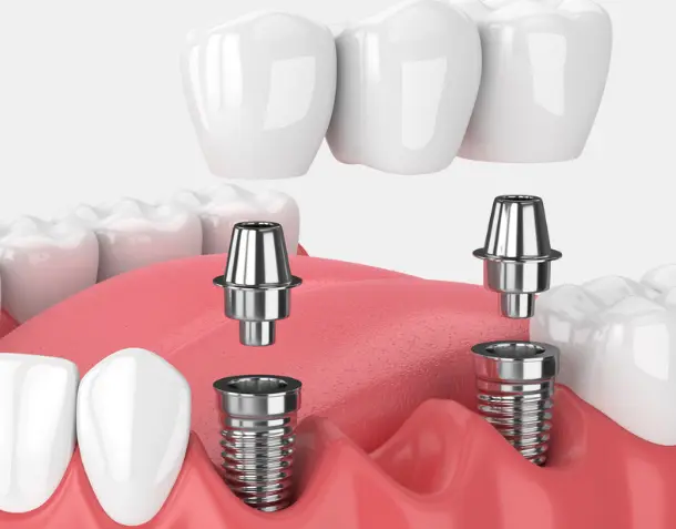 Three Teeth Restoration With Bridge On Implants