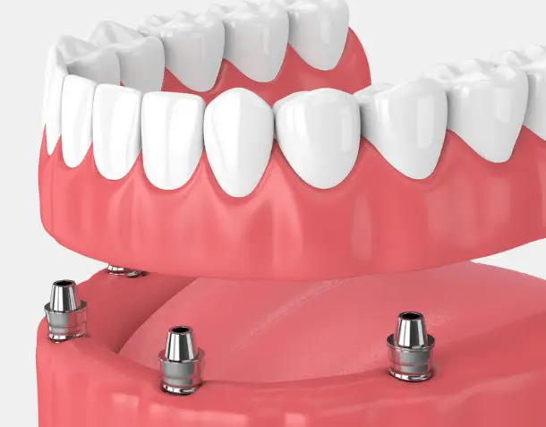 Tooth Restoration With The "All On 4" METHOD