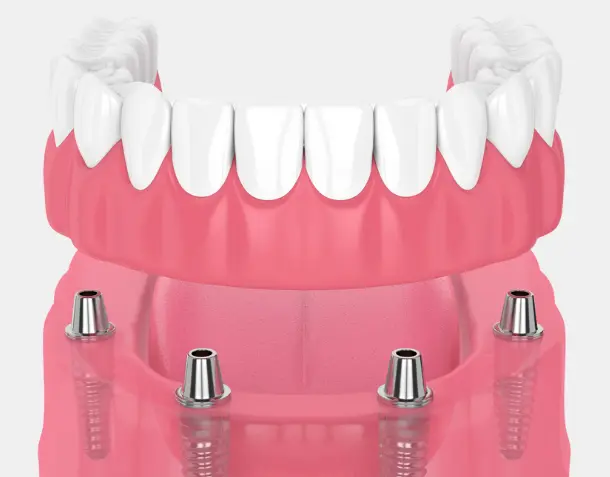 Tooth Restoration With The "All On 4" METHOD Within 24 Hours