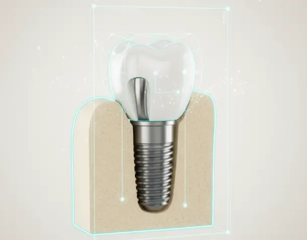 Single Tooth Implantation