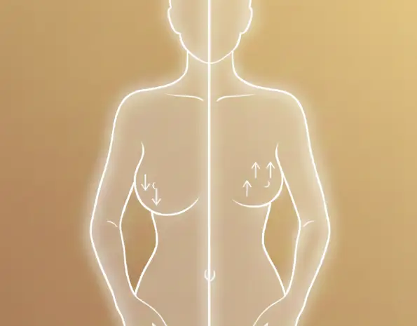 Breast reduction