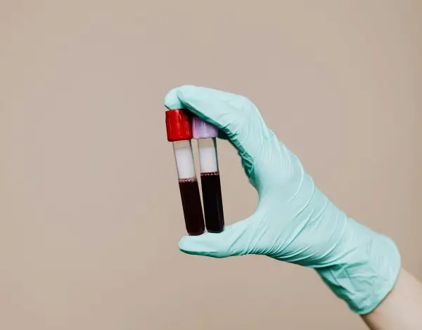 PRP treatment