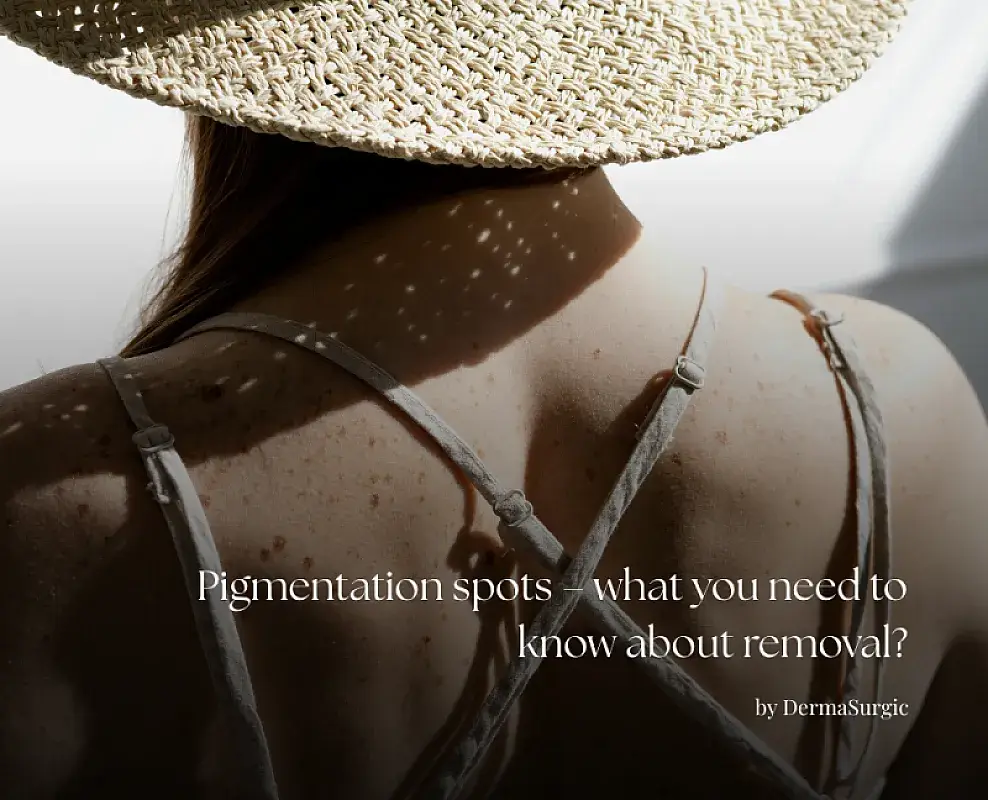 Pigmentation spots – what you need to know about removal?